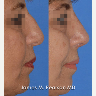45-54 year old woman treated with Rhinoplasty - Patient underwent Rhinoplasty with Dr. Pearson