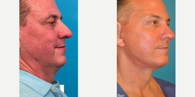 Man treated with Chemical Peel - Man treated with Facelift as well as Neck Lift, Eyelid Surgery, Laser Resurfacing, and Chemical Peel. Patient exhibited the hallmarks of aging face: hooded eyelids, sagging midface, turkey neck and jowls, as well as rough and sun-damaged skin.