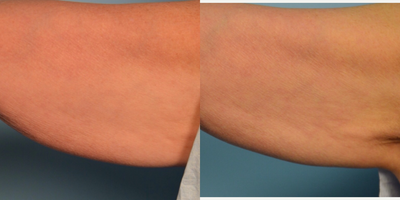 55-64 year old woman treated with Thermage, Skin Tightening - Delve into the journey of a 55-year-old woman as she underwent Thermage to address concerns of arm laxity. Witness the remarkable results that bring back youthful firmness and confidence. Thermage - Elevating Beauty, Defying Age.