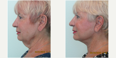 55-64 year old woman treated with Neck Lift and Lower Facelift - This lovely and energetic woman presented to our Center with a 10-year concern of her turkey neck and jowling.  She continues to be quite active and social, and did not feel that the droopiness of her lower face and neck matched her internal energy.  At initial consultation, she stated that she did not want to take the risk of undergoing general, or IV, anesthesia for an elective procedure.  She was informed that procedures performed at our Center were all performed under local anesthesia, which she found appealing.An hour prior to procedure she was administered a small dose of valium to relieve any anxiety.  The procedure was performed under local anesthesia in two hours time.  Results demonstrate marked improvement in her profile with refinement of her jawline.  In under two weeks after procedure she was able to return to all physical activity and her social life.