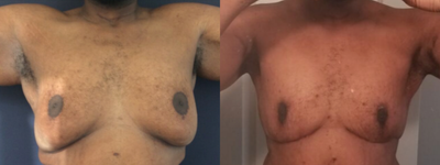 45-54 year old man treated with Breast Reduction - Before and after photos from a Breast Reduction patient.