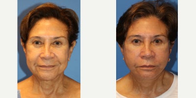 65-74 year old woman treated with Facelift, Facelift Revision - This is a 74 year old female presenting for a revision facelift. She had undergone a facelift 10 years in the past and presents with recurrent skin laxity, jowling, volume loss and loss of the jawline angle. She underwent a revision facelift using a SMAS plication technique and fat grafting to contour temples, nasolabial folds and other areas of volume loss. Photos are before and 3 months post op demonstrating well healed preauricular (around the ear) incisions, submental incision and overall more youthful, rejuvenated contour. Dr. Lipschitz's goal with a facelift is to perform a safe operation using the most advanced surgical techniques to provide a natural looking result.