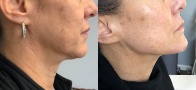 55-64 year old woman treated with Liquid Facelift - Lower face ylift done on patient with juvederm voluma and juvederm ultra plus xc