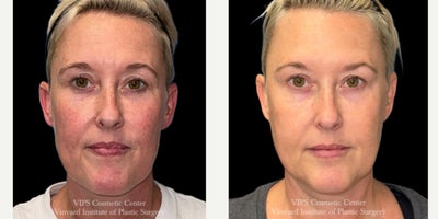 45-54 year old woman treated with Skin Rejuvenation, IPL - This 45-54 year old female patient completed three Elluminate Advanced Photofacial treatments with IPL to target redness, pigmentation, and uneven tone. Her results show a brighter, more even complexion with reduced redness and improved skin clarityrevealing a smoother, naturally radiant glow with little to no downtime.