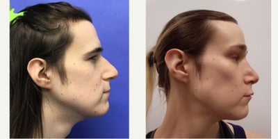 35-44 year old transgender woman treated with Brow Lift, Forehead Reduction, Septoplasty, Cheek Augmentation, Adam's Apple Reduc - 35 to 44 year-old female patient is 1 year post-op from Facial Feminization surgery. Her procedures included: Forehead Lift, Hairline Lowering, Supra Orbital Bone Reduction and Contouring, Septorhinoplasty (closed) with Cartilage Grafts and Weirs, Cheek Implants (small combined), Chin Reduction and Contour, Thyroid Cartilage Shave, 300 Micrografts to the Frontotemporal Recessions, Lip Lift, Fascia to Lips, Soft Tissue to Nasolabial Folds, Lower Eyelid Blepharoplasty (TC), and 1 cc Juvederm to Facial Rhytids.