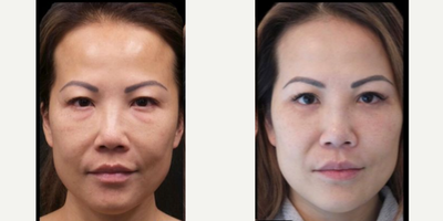 35-44 year old woman treated with Nonsurgical Facelift - Remarkable transformation at 44!After lower blepharoplasty, fat transfer to the face, and Contour Lift Face, the results speak for themselves. Rejuvenate and redefine your beauty with us.