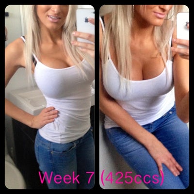 Love Love Love my New Breasts. Life Changing!! - Review - RealSelf