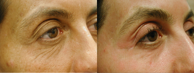 Madonna Lift - 	The Madonna Lift is a new type of laser eyelift. It utilizes an innovative fractional CO2 laser which creates tiny microscopic channels in the tissue so that new collagen can grow in to rejuvenate the skin. It dramatically reduces the appearance of dark rings and wrinkles while tightening eyelid skin and elevating drooping eyebrows.