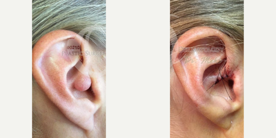 Patient treated with Lipoma Removal - Patient treated with Lipoma Removal on ears