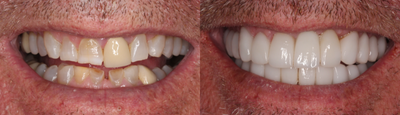 55-64 year old man treated with Dental Implants - When a patient loses a front tooth due to non-restorablility, it's not the challenge you think it may be. Using a fixed bridge as a temporary in the interim, the transition to a restored mouth becomes is a little easier. These photos depict a full mouth restoration, including implant replacement of the front tooth.
