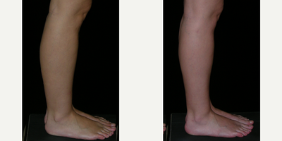 25-34 year old woman treated with Calf Reduction - Before and 6 months after liposuction for medial knees, calves and ankles.