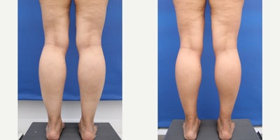45-54 year old woman treated with Liposuction, Laser Liposuction, Tumescent Liposuction, Power-Assisted Liposuction (PAL), Calf  - Before and 7 months after Precision Sculpt awake liposuction or Ankles and Calves.