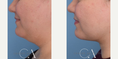 32 year old woman treated with Chin Liposuction - 32 year old patient concerned with under-chin fat. Neck liposuction is done with Dr.Cheryl Karcher.Photos pictured: 2 months post-surgery. Results will continue to improve up to 6 months.