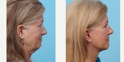 55-64 year old woman treated with Facelift - This patient in her 60s was concerned with the laxity and folding of her neck skin and overall tired look. She wanted to look refreshed. She had a facelift 1 year ago to elevate the structures of her neck. Note the decrease wrinkling of her neck and the decrease in hanging jowl.
