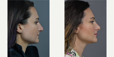 25-34 year old woman treated with Rhinoplasty - Patient is 6 months post op Cosmetic & Functional Rhinoplasty.She presented at consult with complaints of breathing difficulty, unhappiness overall size and dorsal hump.Assessment of the patient revealed a deviated septum, hypertrophy of nasal turbinates and desired cosmetic change. The patient appeared to be a good candidate for primary open rhinoplasty, septoplasty and inferior turbinate reduction for treatment of the aforementioned deformities. The goals for treatment included an increase in tip rotation, shorten the nose, narrow the tip, reduce dorsal hump and narrow the bony base. The recommended plan included cephalic trim for the tip, dome sutures for the tip, columella strut for the tip, tip graft, to take down hump and an osteotomy for open roof for the dorsum.