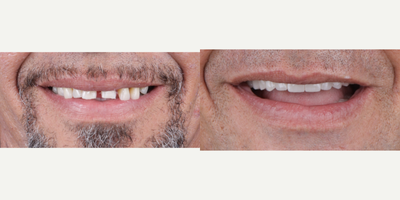 45-54 year old man treated with BriteSmile, ClearChoice Dental Implants, Dental Bone Graft, Dental Implants, Porcelain Veneers,  - Dental implants, All on 4