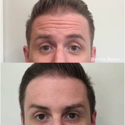 25-34 year old man treated with Botox - Botox results at The Skin Center Pittsburgh!