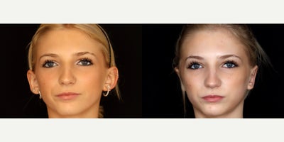 16 year old female  treated with Ear Surgery (otoplasty) - 16 year old female treated with otoplasty (ear pinning) photos depict before and 4 months after surgery.