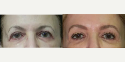 55-64 year old woman treated with Thermage - 55-64 year old woman treated with Thermage