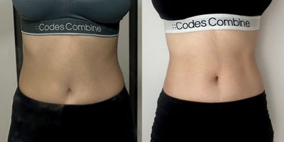 25-34 year old woman treated with Lipodissolve - Fat-dissolving injections for slimming the abdominal area