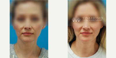 35-44 year old woman treated with Mini Neck Lift - 38 year-old female who underwent deep mini neck lift for neck rejuvenation and jawline contouring.