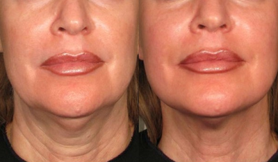 Ulthera - 
	Ultherapy - Neck
