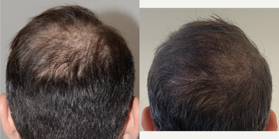 45-54 year old man treated with Scalp Micropigmentation - Before and after scalp micropigmentation into the crown to provide a fuller appearance.