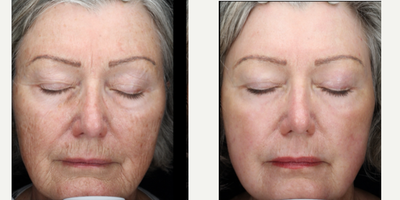 65-74 year old woman treated with Scar Removal, Laser Scar Removal - Full face laser resurfacing