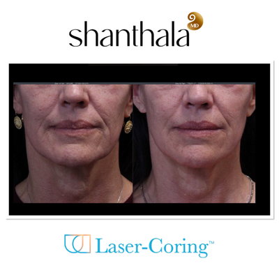 UltraClear Laser & Laser-Coring by Dr. Shanthala - Laser-Coring with UltraClear Laser was performed after Cheek volume correction, under eye fillers & lip fillers on the same day by Dr. Shanthala