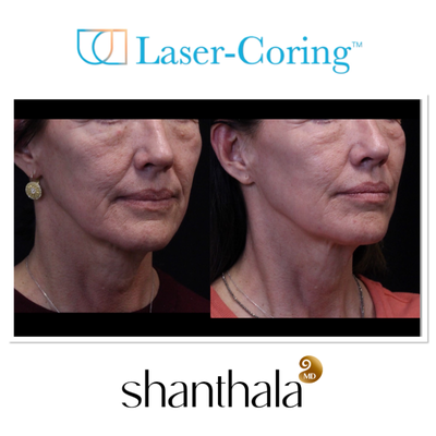 UltraClear Laser & Laser-Coring by Dr. Shanthala - Laser-Coring with UltraClear Laser was performed after Cheek volume correction, under eye fillers & lip fillers on the same day by Dr. Shanthala