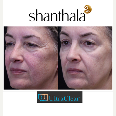 UltraClear  Laser-Coring  by Dr. Shanthala - Laser-Coring with UltraClear laser ( never had any fillers or botulinum toxin ) has helped improve her acne scarring, peri-orbital rejuvenation, and fuller cheeks & youthful results performed by MD only.