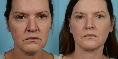 55-64 year old woman treated with Lower Facelift - Lower Facelift with Fat Grafting to Lower Eyelids  Had significant aging changes including the jowls.