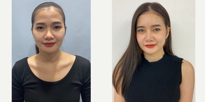 25-34 year old woman treated with Cheekbone Reduction - Cheekbone ReductionFull Face Fat Grafting