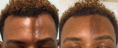 ALMI (Autologous Lipocyte Micronized Injection) for correction of Craniofacial abnormality - This male patient presented with an indentation on his forehead from a craniofacial abnormality present since birth. ALMI (Autologous Lipocyte Micronized Injection) was used to fill in the indentation, dramatically improving his appearance. ALMI is a technology that uses your own fat and stem cells to rejuvenate and revive different areas of the face, hands, body, as well as for hair restoration.