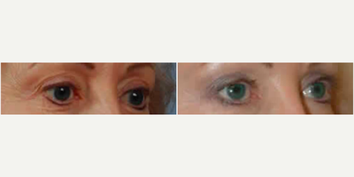 Eyelid Surgery - Eyelid Surgery