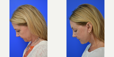 55-64 year old woman treated with Brow Lift, Facelift - Brow and neck lift on this 53 year old. She has a soft refreshed appearance and no one askes her if she is mad anymore!