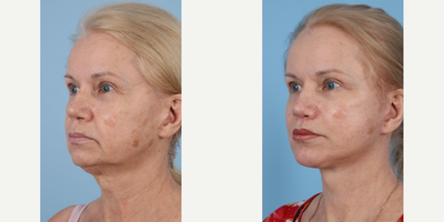 Woman treated with Lip Lift - Face and neck lift revision (secondary, deep plane technique, lip lift, chin augmentation, fat transfer, alar reduction