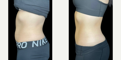 truFlex - truSculpt Flex is a personalized muscle sculpting device to tighten, tone, abs strengthen your muscles on your: