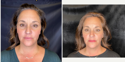 45-54 year old woman treated with AccuTite - Minimally invasive neck and face contouring with FaceTite and Accutite.FaceTite and Accutite provide dramatic improvement in skin laxity on the face and neck, which was previously only attainable through a surgical procedure such as a facelift. FaceTite and Accutite utilize minimally invasive radio-frequency energy to melt fat and tighten skin. By avoiding a facelift excisional procedure, patients will be scar free and will benefit from reduced post-procedural swelling and discomfort. This is a less traumatic process with a natural looking final result. Results can be seen immediately, with best results noticeable after 6-12 weeks.