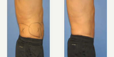 Man treated with CoolTone, CoolSculpting - Man treated with CoolTone, CoolSculpting