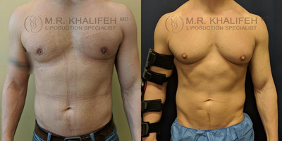 25-34 year old woman treated with Laser Liposuction - This is a thin man who had stubborn fat in abdomen and lower back flanks, treated with awake smartlipo.