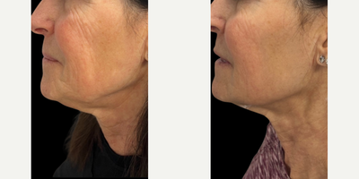 Woman treated with Sylfirm X - Woman treated with Sylfirm X