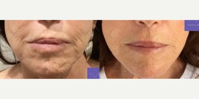 Woman treated with RHA Collection Fillers - These pictures are seven months apart - from November 2019 to June 2020. Can you believe this stunning lower-face transformation was achieved ONLY with fillers?! The top picture is the last time we saw this patient last November. The bottom is from June.