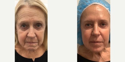 Woman treated with RHA Collection Fillers, Chemical Peel - I have been seeing my internist for over ten years and during my last visit he said, I see your age on your chart but you look twenty years younger!- our patient.Our beautiful patient came to Dr. Marmur last year with the desire to restore both her skin and her confidence.She has been treated with fillers, neuromodulators, lasers, chemical peels and MM skincare genius skin care routine over the past year. Look at the transformation!!!