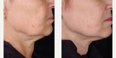 Woman treated with Titan Laser - Woman treated with Titan Laser