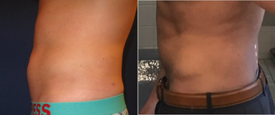 25-34 year old man treated with SculpSure - This male patient has been treated twice in the lower abdomen with SculpSure. He has a healthy lifestyle full of exercise. He drinks plenty of fluids and has had 1 lymphatic massage post treatment.
