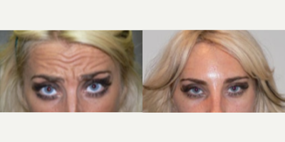 Woman treated with Botox - Woman treated with Botox
