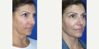 Woman treated with Profound RF - Check out the results of this patient who wanted a non-surgical treatment to address the sagging jowls in her lower face and skin laxity around her neck. Profound RF was used to treat her concerns which significantly contoured her jawline and redefined her neck with only one treatment (7 month results)