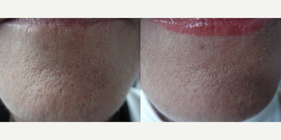 Infini RF - Photo provided courtesy of Lutronic, performed by Ivan Perez Haded, MD