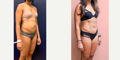 25-34 year old woman treated with Vaser Liposuction, Liposculpture, Abdominal Etching - This lovely out-of-state patient underwent liposuction by another surgeon on the West coast, but was unhappy with the result. She consulted with other providers but finally settled on having her surgery with me. She was already athletic but wanted to have definition to show the fruits of her hard work a little more, especially after her pregnancies. She is shown 1 year post-op from high-definition liposuction using Vaser to define her abdomen. She finally loves her results!